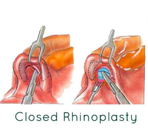 Rhinoplasty Surgery 50 rhinoplasty in India