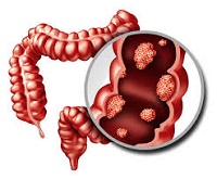 cancer treatment in India | MedicoExperts