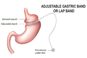 gastric-band-surgery