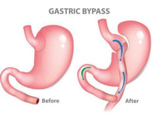 gastric-bypass