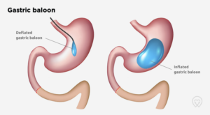 intragastric-baloon