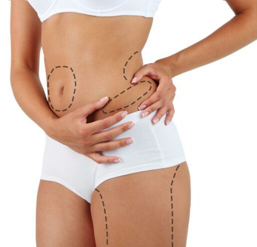 liposuction procedure 2 liposuction procedure 2