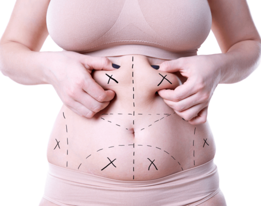liposuction in india, best liposuction in india