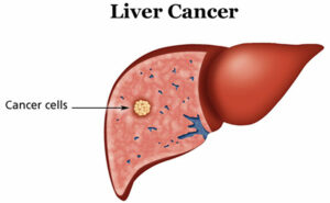 cancer treatment in India | MedicoExperts