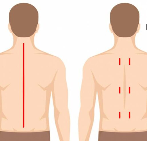 miss Minimally Invasive Spine Surgery in India