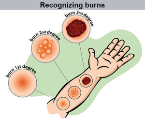 burn injuries treatment