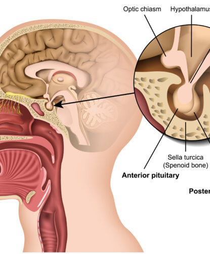 Pituitary gland anatomy 3d medical vector illustration isolated on white background hypothalamus in human brain eps 10 infographic Diagnose Pituitary tumor