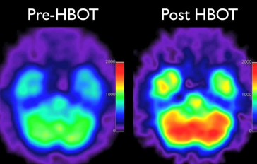 pre-&-post-HBOT