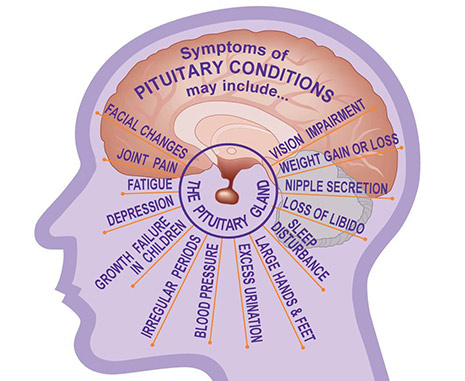 pt-Symptoms Pituitary Tumor Treatment in India