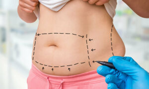 tummy-tuck-surgery