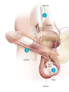 Penile Implant for erectile dysfunction