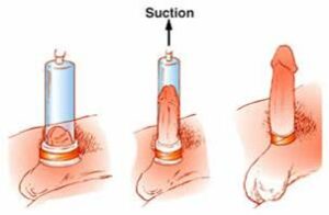 Penis pump for erectile dysfunction