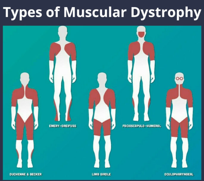 muscular-dystrophy-treatment-in-india