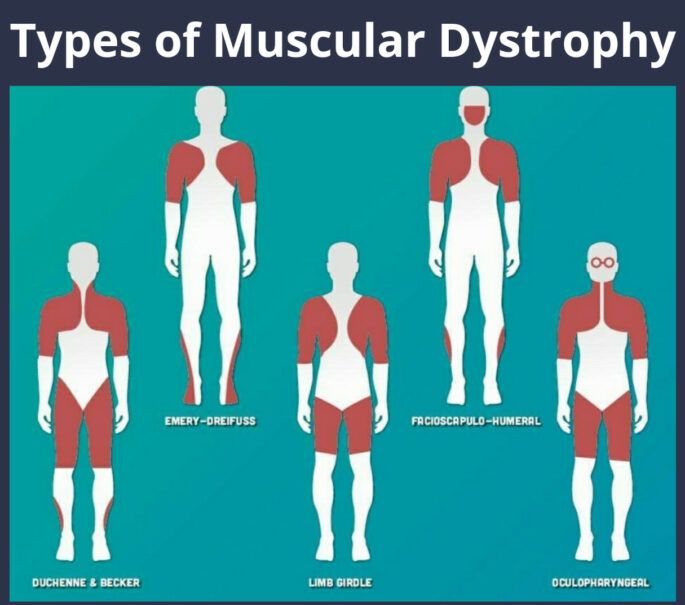 muscular-dystrophy-treatment-in-india, muscular dystrophy treatment , becker muscular dystrophy treatment, duchenne muscular dystrophy treatment in india