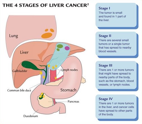 4 stages of liver cancer 4 stages of liver cancer