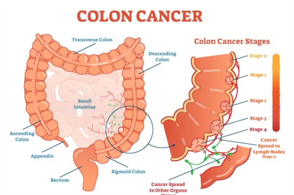 colon cancer treatment cost in india, colon cancer treatment in india