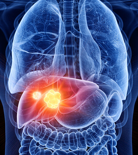 Liver-Cancer-treatment in india Liver-Cancer-treatment in india