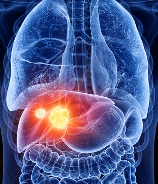 Liver Cancer treatment in india, best liver cancer treatment in india