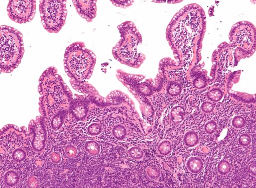 Non hodgkin lymphoma cells Non hodgkin's lymphoma cells, non hodgkin's lymphoma treatment in india