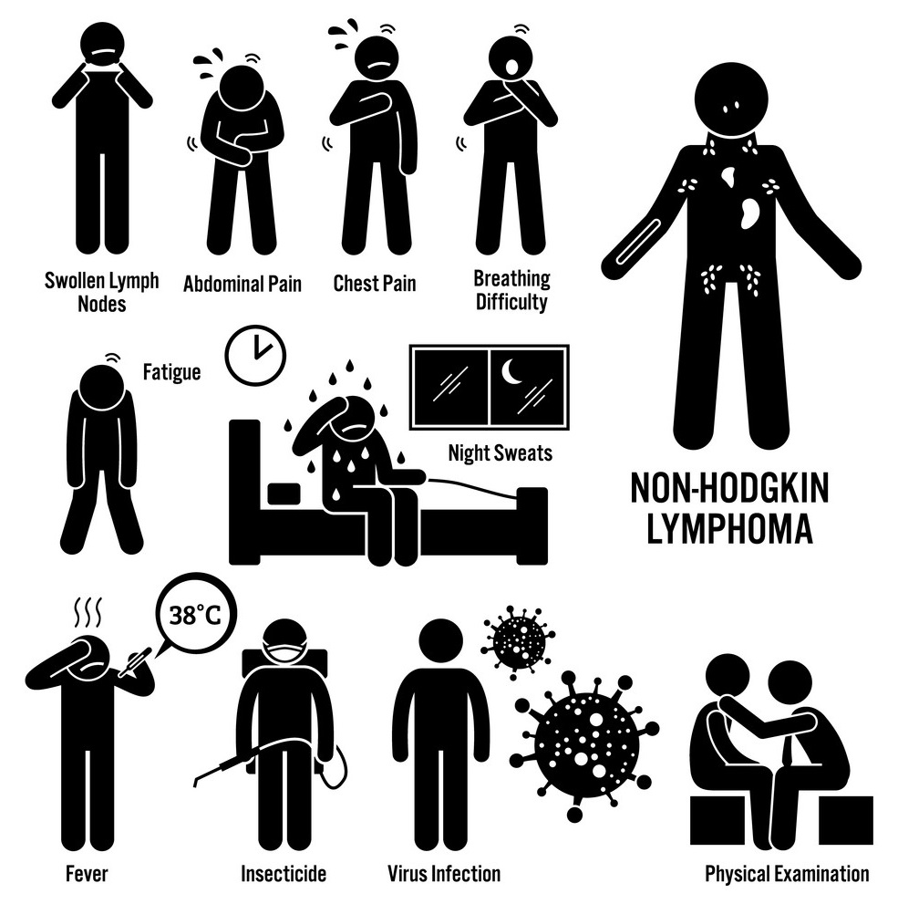 Different signs and symptoms of non hodgkin's lymphoma, non hodgkin's lymphoma symptoms