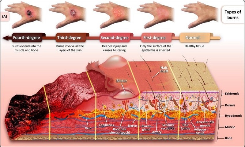 burn injury treatment