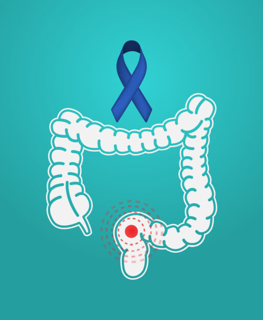 what are the causes of colon cancer, colon cancer treatment in india