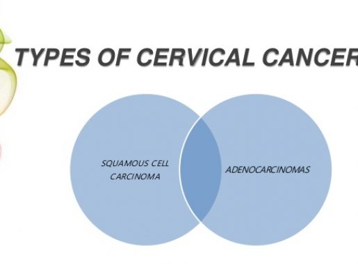 different types of cervical cancer, stages of cervical cancer