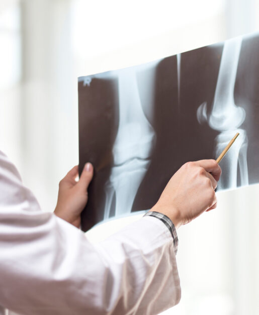 knee xray knee xray