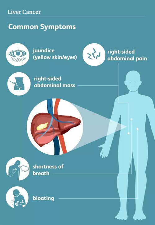 liver cancer sign and symptoms