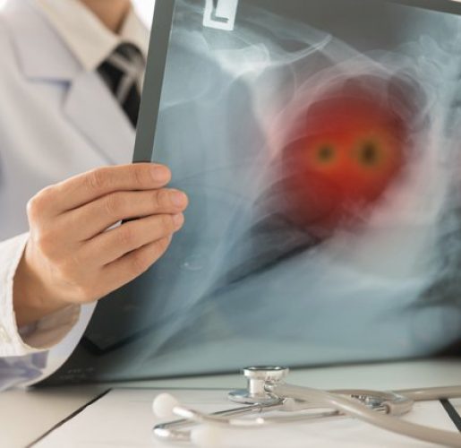 lung-cancer-xray_adobe best lung specialist in india, best hospital for lung cancer treatment in india