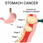 stages of stomach cancer