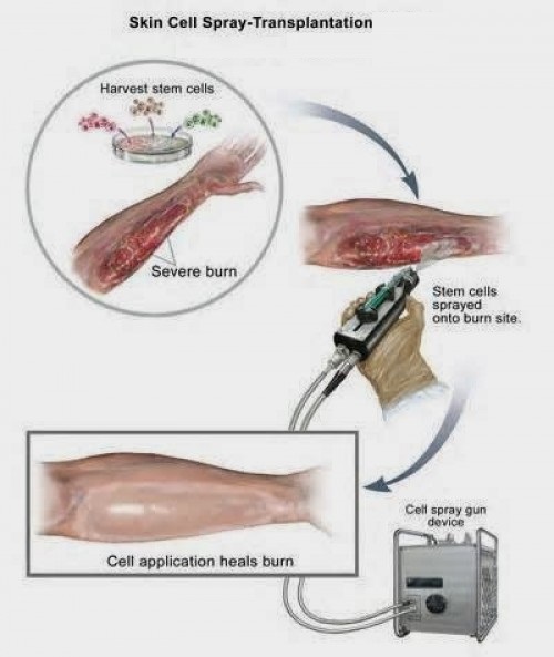 burn injury treatment