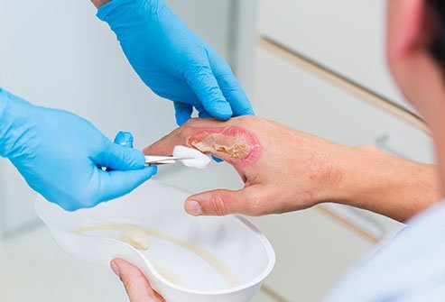 symptoms of burn injuries symptoms of burn injuries