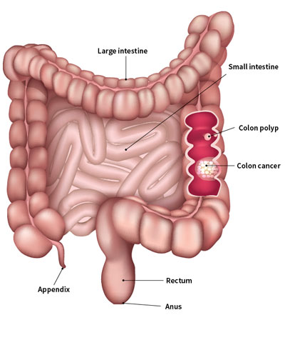 colon cancer treatment in india, best colon cancer hospital in india