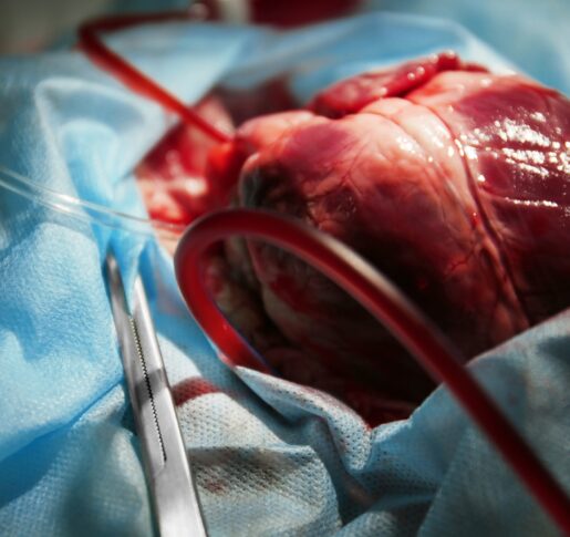 Process of heart transplant in india