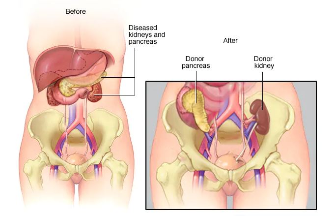 Procedure for pancreas transplant