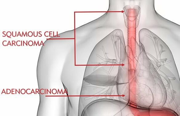 Types of Esophageal Cancer Types of Esophageal Cancer
