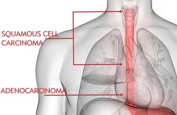 Types of Esophageal Cancer Types of Esophageal Cancer, treatment for esophageal cancer