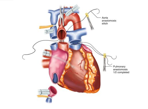Orthotropic heart transplant
