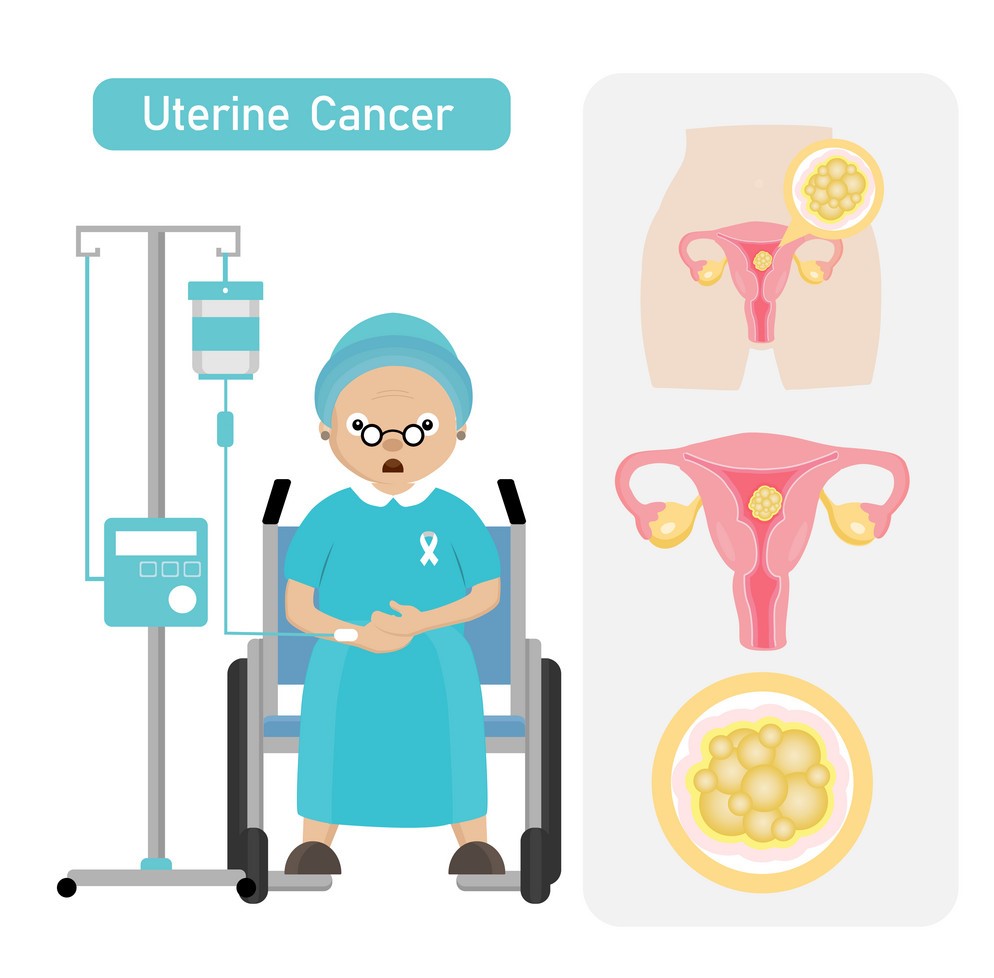 Uterine cancer