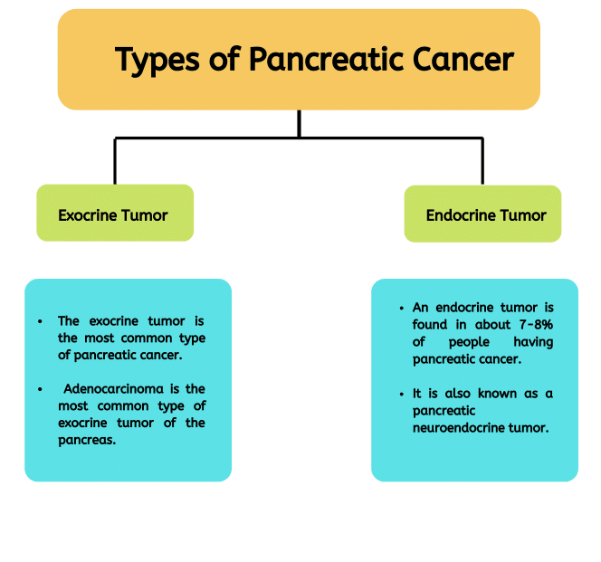 types of pancreas cancer, best oncologist for pancreatic cancer