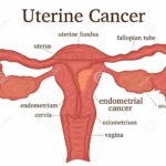What is Uterine Cancer