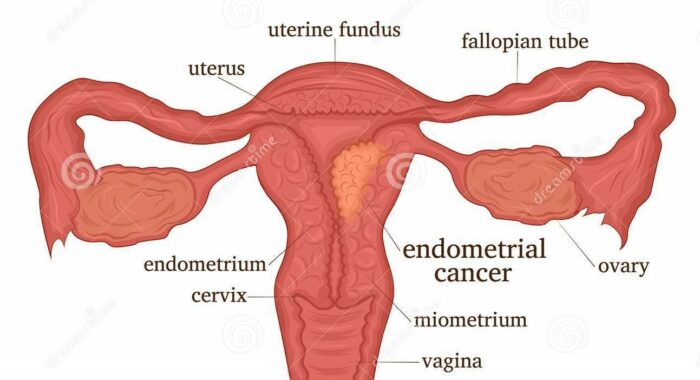 What is Uterine Cancer, treatment of uterus cancer in india