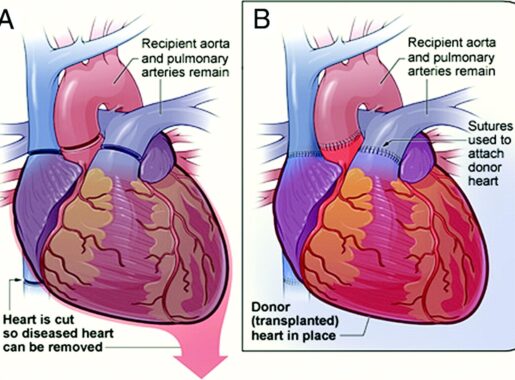 Steps of heart transplant
