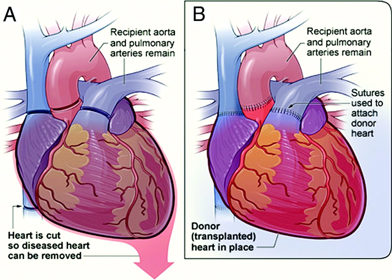 what is eligibility for heart transplant