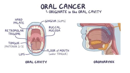 what oral cavity cancer is, oral cancer survival rate, oral cancer treatment success rate