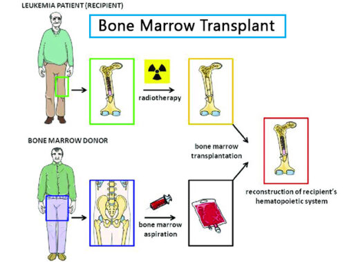 bone marrow transplant in india