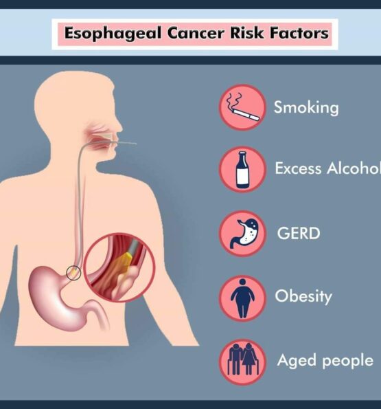 causes of esophageal cancer, what cause esophageal cancer, causes of esophageal cancer