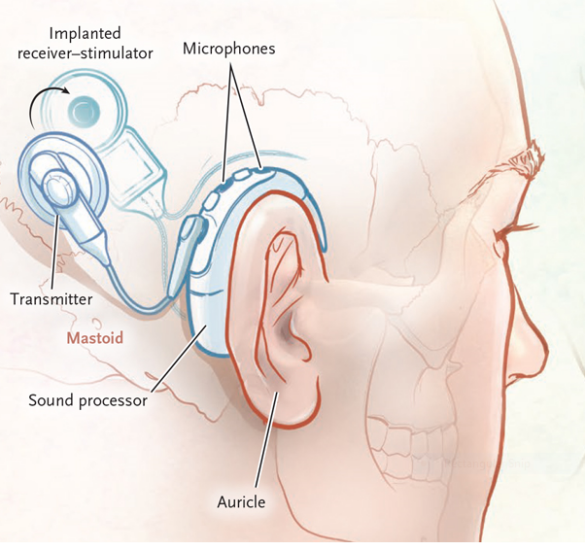 what is cochlear implant