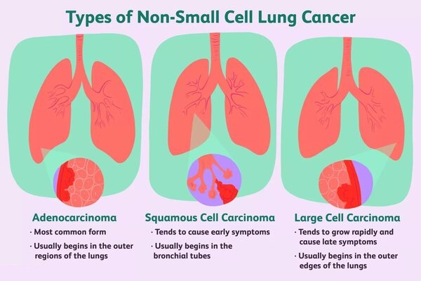 Non Small cell lung carcinoma treatment in india, lung cancer survival rate in india